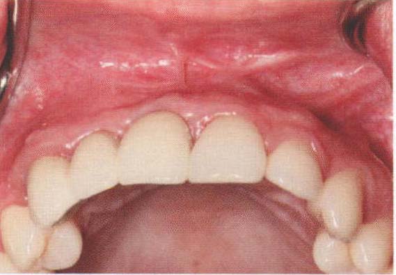 上颌连续多颗前牙缺失伴重度牙槽突水平向骨量不足应用钛网植骨技术的种植美学修复